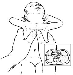  Figur 3    Hjertekompresjon hos nyf&oslash;dt (3)