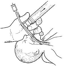  Figur 4    Nedf&oslash;ring av trakealtube ved avansert hjerte-lunge-redning hos barn (3)
