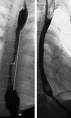  Figur 1    a) R&oslash;ntgenunders&oslash;kelse av &oslash;vre gastrointestinaltractus som viser innsnevring og forsinket kontrastpassasje i&hellip;