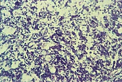 Figur 5    Traumatisert biopsi fra pasient 5. Cellene er sammenklemte med deformerte og hyperkromatiske kjerner. Uegnet til&hellip;