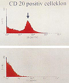 Figur 7    V&aelig;skestr&oslash;mscytometri av finn&aring;lsaspirat fra lavgradig malignt lymfom f&oslash;r og etter behandling.  a) CD20-positiv&hellip;