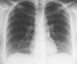 Figur 1  Normal r&oslash;ntgen thorax ved innkomst