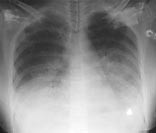 Figur 2  Omfattende bilaterale fortetninger med luftbronkogrammer p&aring; nytt bilde tatt 36 timer senere