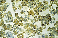 Figur 2  Ascitesv&aelig;ske med et stort antall karsinomceller med b&aring;de membran&oslash;s og cytoplasmatisk immunreaktivitet for B-72.3