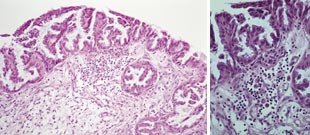 Figur 1    a) Ser&oslash;s papill&aelig;r tumor av borderlinetype med lite omr&aring;de med karsinominfiltrasjon i stroma.  b) St&oslash;rre&hellip;