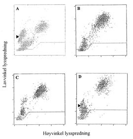 Figur 2    Serie med lysspredningsdiagrammer fra en helautomatisk blodcelleteller (CellDyn 3500) av pr&oslash;ve fra en pasient med&hellip;