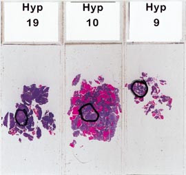 Figur 2    Patologen merker det mest atypiske omr&aring;det i det histologiske snittet f&oslash;r bildeanalysen utf&oslash;res