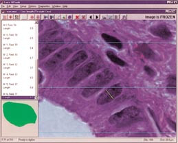 Figur 4    Utsnitt av cellekjerner i endometriekjertler ved hyperplasi. Korteste kjerneakse er vist merket i en kjerne i&hellip;