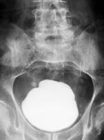  Figur 1    Oversiktsbilde som viser en stor forkalkning i bl&aelig;reregionen