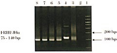 Figur 5    PCR fra pasient 2 for p&aring;visning av monoklonalitet for immunglobulin tung kjede (9, 10). PCR-produktene fra en&hellip;
