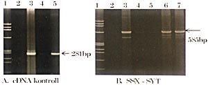 Figur 7    Revers transkriptase-PCR fra pasient 3 for p&aring;visning av fusjonsproduktet for&aring;rsaket av t(X;18)-translokasjon. Med&hellip;