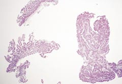 Figur 10    Lysmikroskopisk bilde av tynntarmsbiopsier fra pasient 5 (HE, 2,5 &sdot; ). Et fragment av adenokarsinom av&hellip;
