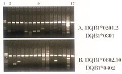 Figur 11a og b    Allelspesifikk PCR fra pasient 5 for typing av HLA DQB1-gener. Br&oslash;nn 2 &ndash; 17: 16 PCR-reaksjoner. Br&oslash;nn 1:&hellip;