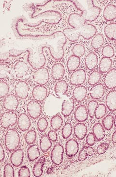Figur 2    En krypt fra normal colonslimhinne er mikrodissekert ut (HE, 100 &sdot; )