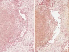 Figur 3    F&oslash;r og etter manuell mikrodisseksjon av et tumoromr&aring;de i en levermetastase fra coloncancer. For &aring; f&aring; rent&hellip;