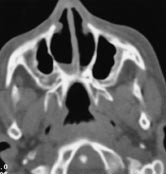 Figur 2  Aksialt CT-bilde ved dobbeltsidig koanalatresi. Septum er midtstilt. Begge siders processus pterygoideus er medialt&hellip;