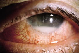 Figur 1  Akutt postoperativ endoftalmitt to dager etter kataraktoperasjon. Merk kraftig konjunktival injeksjon, uklar cornea&hellip;