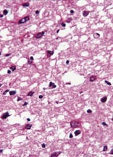 Figur 3  Histopatologibilde av nucleus caudatus hos aktuell pasient med Creutzfeldt-Jakobs sykdom viser typiske spongiforme&hellip;