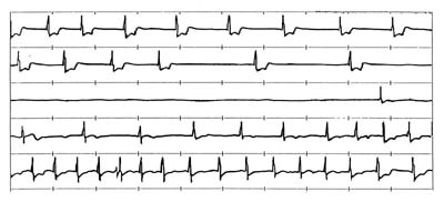 Figur 2  Utskrift av telemetri-EKG fra innoperert arytmidetektor. Pasienten har frosset enhetens minne ved hjelp av&hellip;