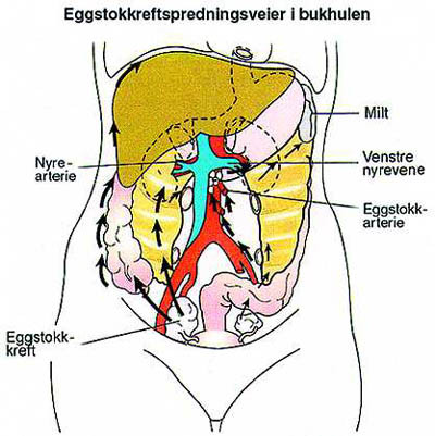 Figur 3b  Eggstokkreftens spredningsveier i bukhulen (15)