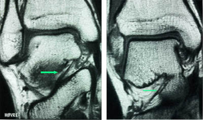 Figur 1  Koronalt T1-vektet snitt gjennom sinus tarsi viser  a) ligamentum interosseusposteri&oslash;rt for b) ligamentum cervicale