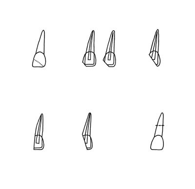 Figur 5  Klassifikasjon av tann- og rotfrakturer som benyttes ved Avdeling for pedodonti og atferdsfag, Det odontologiske&hellip;