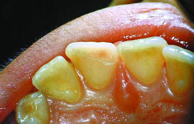 Figur 6  Tannfraktur gjennom pulpa, som sees som en liten, r&oslash;d flekk midt i frakturen Foto I. Jacobsen