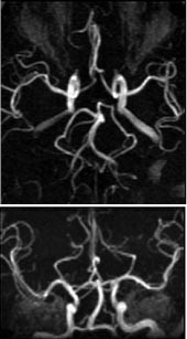 Figur 3  3D-innstr&oslash;mnings-MRA av intrakraniale arterier. Maksimal intensitetsprojeksjon sett nedenfra (&oslash;verst) og forfra &hellip;