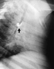 Figur 2 R&oslash;ntgenbilde i sideprojeksjon av en pike p&aring; to &aring;r og sju m&aring;neder som har f&aring;tt implantert en 5 mm spiral med fem&hellip;