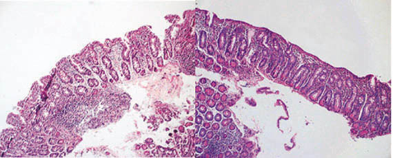 Figur 1a, 1b Tynntarmsslimhinne f&oslash;r og under kumelksproteinfri diett viser sv&aelig;r villusatrofi og kryptehyperplasi, typisk &hellip;