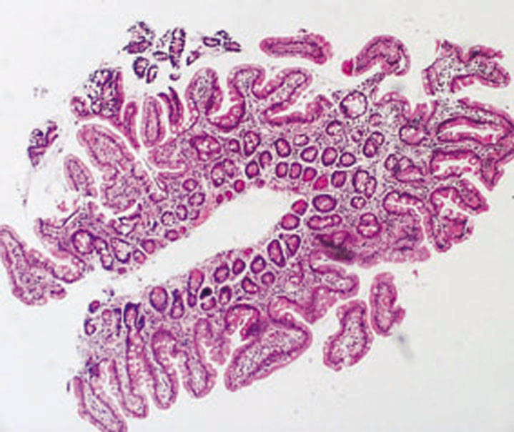 Figur 2 Slimhinnerelieff i tynntarm tre m&aring;neder etter p&aring;begynt glutenfri kost viser betydelig restitusjon med en del n&aelig;rmest&hellip;