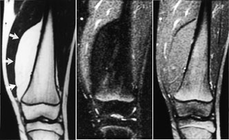 Figur 6  Frontalbilder av dyptsittende lipom i venstre l&aring;r hos 13 &aring;r gammel jente. a) T1-vektet bilde. Tumor har h&oslash;yt signal&hellip;
