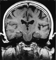 Figur 9  Metastaser til dura. T1-vektet frontalbilde etter intraven&oslash;s kontrast hos 72 &aring;r gammel kvinne med cancer corporis&hellip;