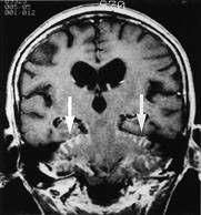 Figur 10  Metastaser til pia. T1-vektet frontalbilde etter intraven&oslash;s kontrast hos 72 &aring;r gammel kvinne med cancer bronchiale&hellip;