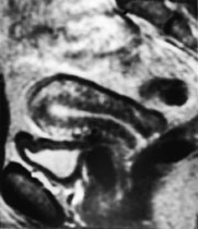 Figur 11  Normalbilde av uterus hos 41 &aring;r gammel kvinne. T2-vektet sidebilde viser tre soner i corpus. Den indre&hellip;