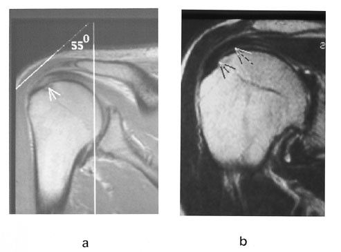 Figur 1  Den magiske vinkel-fenomenet.  a) Skr&aring; koronal T1-vektet sekvens gjennom skulderen viser &oslash;kt signal i&hellip;