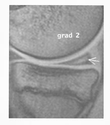 Figur 3  Sagittal gradientekko T1-vektet sekvens av mediale menisk viser et line&aelig;rt h&oslash;ysignal som g&aring;r ned mot meniskens&hellip;