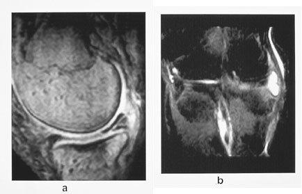 Figur 4  a) Sagittal gradientekko T1-vektet sekvens og b) koronal STIR-sekvens viser type 3 medial meniskruptur med&hellip;