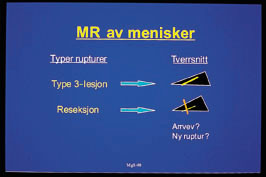 Figur 5  MR uten artrografi i kne med operert menisk. Skjematisk oversikt