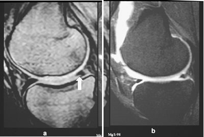Figur 6  a) Sagittal gradientekko T1-vektet sekvens viser et line&aelig;rt h&oslash;ysignal fra reseksjonsranden i operert mediale menisk&hellip;
