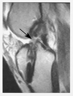 Figur 8  Sagittal T2-vektet sekvens hos en kvinnelig h&aring;ndballspiller viser ruptur av fremre korsb&aring;ndplastikk (pil)