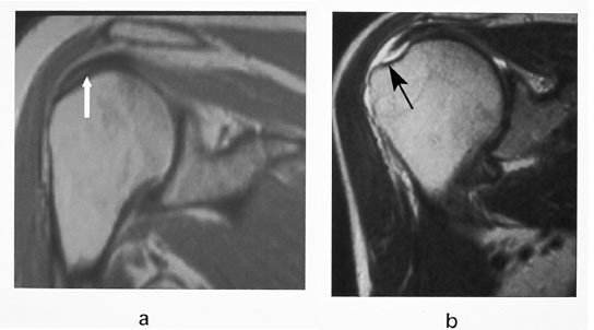 Figur 10  a) Sagittal PD-vektet sekvens viser en normal supraspinatussene (pil). b) En sagittal T2-vektet sekvens hos en&hellip;