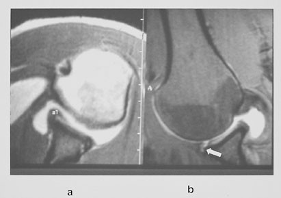 Figur 12  a) MR-artrografi av skulder hos en toppidrettsut&oslash;ver i h&aring;ndball viser normal labrum (al) i aksial T1-vektet&hellip;