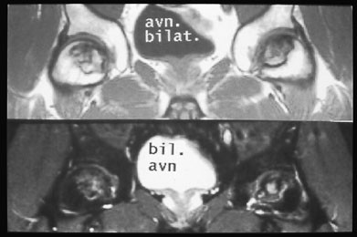 Figur 13  Bilateral avaskul&aelig;r caput femoris-nekrose hos en pasient som behandles med kortikosteroider.  a) T1-vektet sekvens&hellip;