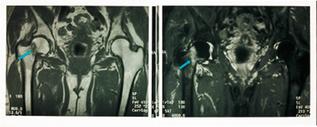 Figur 15  a) Koronal T1-vektet sekvens og b) STIR-sekvens viser en ikke-dislokert collum femoris-fraktur hvor konvensjonell&hellip;
