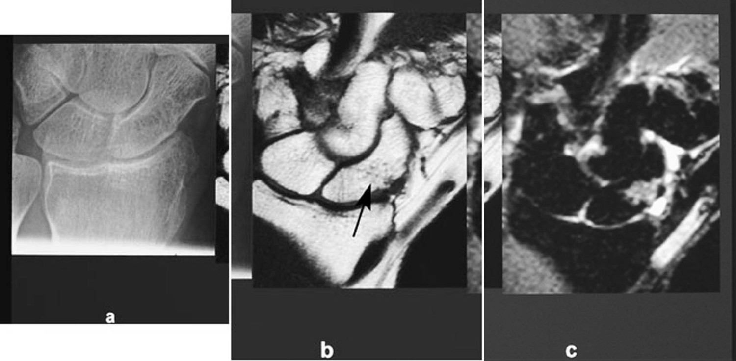Figur 16  Pasient der det er mistanke om os scaphoid-fraktur.  a)  Konvensjonell r&oslash;ntgen er negativ.  b) Koronal T1-vektet&hellip;