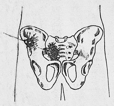  Figur 1    Aleksander Pusjkins skuddskade. Kulebanen g&aring;r igjennom h&oslash;yre os iliaca, nedre del av bukhulen og gjennom h&oslash;yre&hellip;
