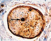  Figur 3    Mikrofotografi av nervefascikkel med immunopositivitet for lambda lette kjeder hos pasient med prim&aelig;r systemisk&hellip;