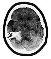  Figur 3    CT caput fra pasient 2. Det sees blod til h&oslash;yre for pons (&aring;pent pilhode)