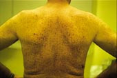 Figur 2    Makulopapul&oslash;st utslett p&aring; ryggen, typisk for urticaria pigmentosa, hos pasient 2. Pasienten hadde utbredte&hellip;